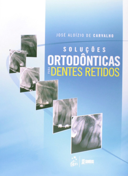 Soluções Ortodônticas Para Dentes Retidos