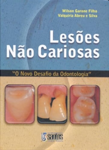 Lesões Não Cariosas Novo Desafio Da Odontologia