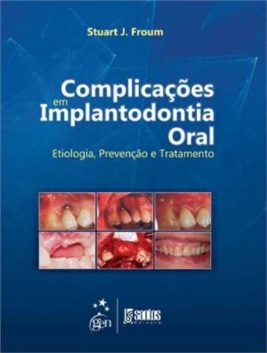 Complicações em Implantodontia Oral - Etiologia, Prevenção e Tratamento