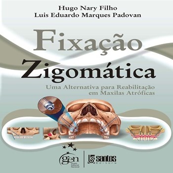 Fixação Zigomática