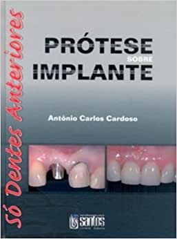 Prótese Sobre Implante Só Dentes Anteriores