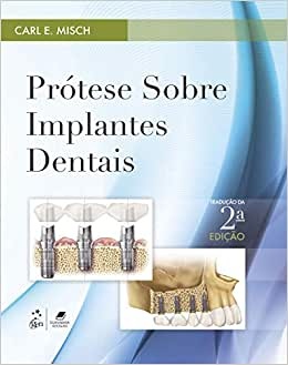 Prótese Sobre Implantes Dentais