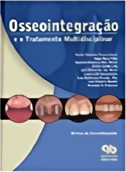 Osseointegração E O Tratamento Multidisciplinar