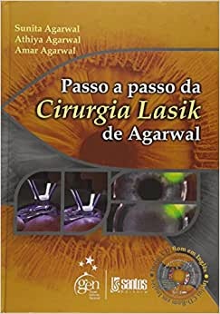 Passo A Passo Da Cirurgia Lasik De Agarwal