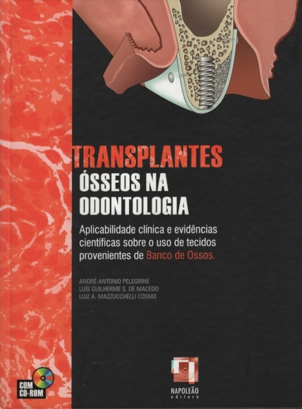 Transplantes Ósseos na Odontologia