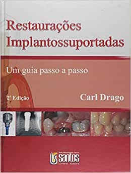 Restaurações Implantossuportadas Guia Passo A Passo