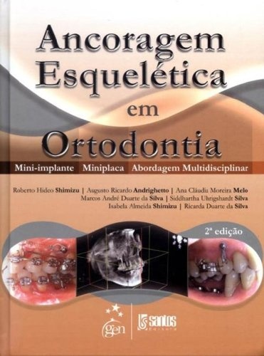 Ancoragem Esquelética Em Ortodontia Mini-Implante