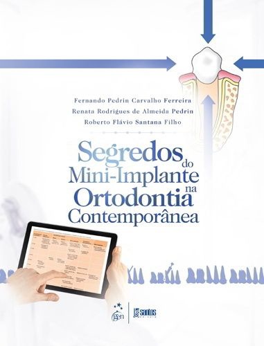 Segredos Do Mini-Implante Na Ortodontia Contemporânea